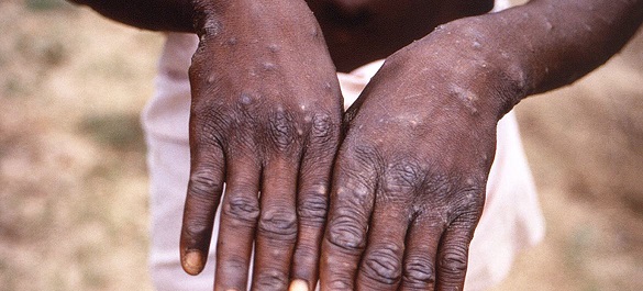 Animal-to-human diseases on the rise in Africa, WHO warns 