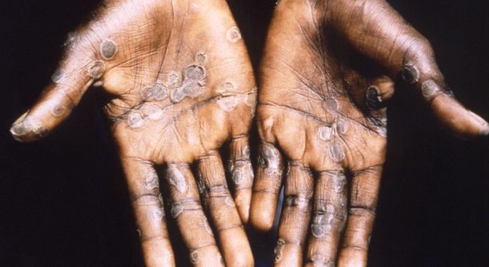 Monkeypox, what to know