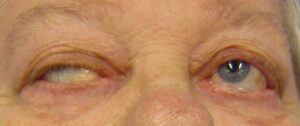 MYASTHENIA GRAVIS, Holistic Therapy, Walter Last, Causes, Nutritional Factors, Holistic Theory, DIET, Supplements